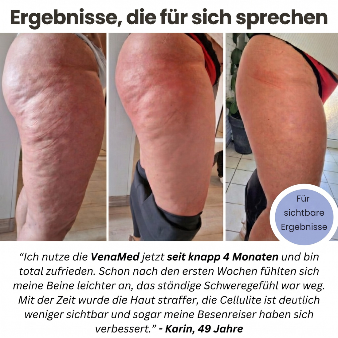 VenaMed Shorts - Kurze Kompressionsleggings I Erleichterung bei Venenbeschwerden & schweren Beinen